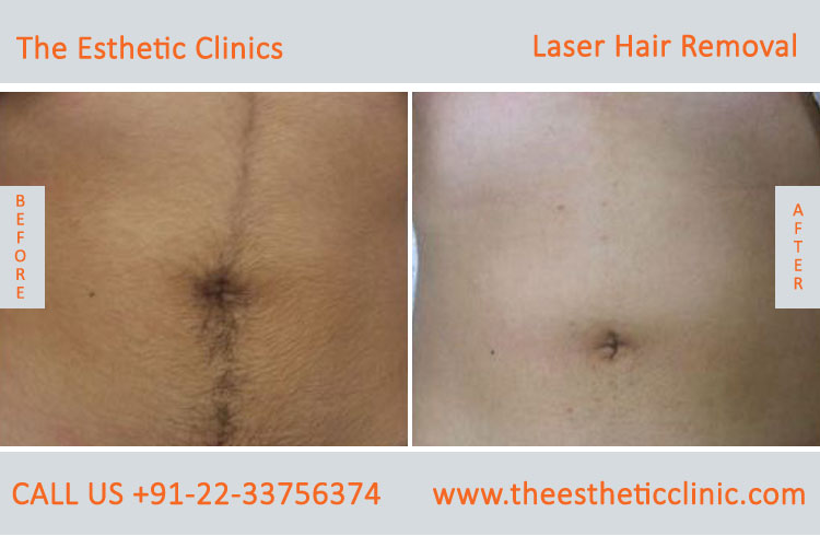Permanent Laser Hair Removal Treatment before after photos in mumbai india (5)
